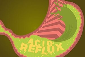 Acid Reflux